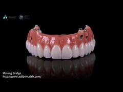 Composite Pink Porcelain Crown A1 Shade All On 4 Hybrid Titanium Screw Retained