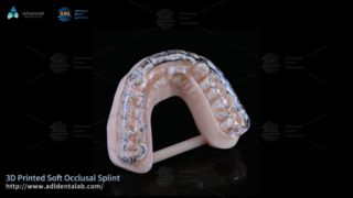 Custom 3D Printed Splint for Bruxism Comfort