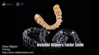 Invisible Aligners Faster Straighter Smile