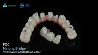 Hybrid Implant Malo Bridge Secure Smile