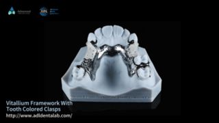 Vitallium Framework Natural Esthetics Easy Fit