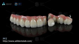 PFZ Dental Crowns Natural Strength and Precision Fit