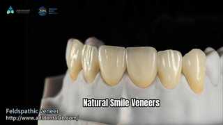 Natural Smile Veneers High Translucency Feldspathic Ceramic