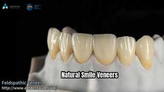 Natural Look Veneers 0.3-0.7mm Feldspathic Ceramic