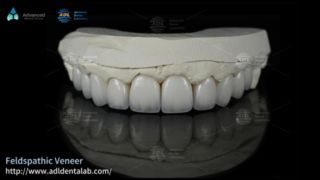 High Translucency Feldspathic Ceramic Veneers for Smiles