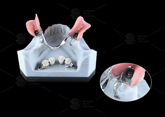 Buy 0.1mm Tolerance CEKA REVAX Attachment Titanium 3mm Vertical Clearance online manufacture