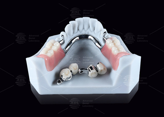 Buy CEKA M2 Precision Attachment Titanium With 3mm Horizontal / Vertical Clearances online manufacture
