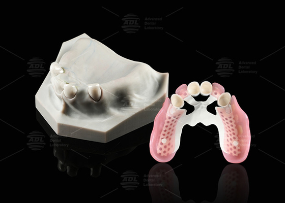 Buy Biocompatibility Dental Telescope White Inner Zirconia Outer Peek Telescope Dental online manufacture