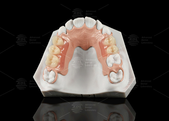 Buy White And Pink Peek Flexible Acrylic Partial Denture With Excellent Resistance online manufacture