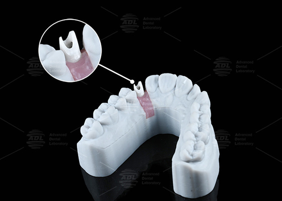 Buy White Custom Zirconia Abutment Natural Looking Aesthetics And Optimal Functionality online manufacture