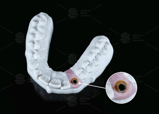 Buy Internal Hex Custom Titanium Abutment Screw Cement Retained Varying Shape online manufacture