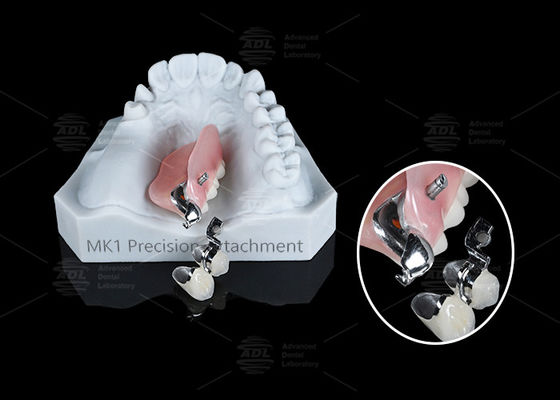 Buy MK1 Attachment Dental Prosthesis Silver Partial Denture Precision Attachments online manufacture
