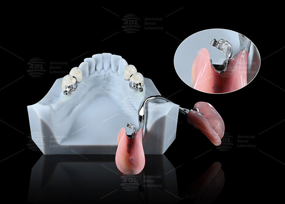 Buy Sleek Precision ERA Dental Attachments For Universal Secure Dental Prosthetics online manufacture