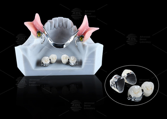 Buy CE FDA Ball Attachment Dentures Comfortable Denture Ball Attachment Long Lasting online manufacture