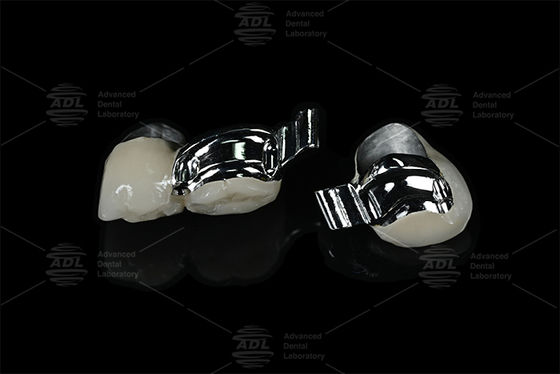 Buy China Dental Lab Adjustable Patient Specific Keyway Precision Attachment with PFM online manufacture