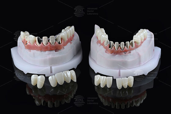 Buy China Dental Lab Titanium Full Arch Hybrid Bridge with Immediate Loading A1 Shade Malong Design Screw Retained Cad/Cam online manufacture
