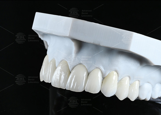 Translucency CAD EMAX Veneer Polished Glazed Ceramic Restorations For Anterior Posterior Areas