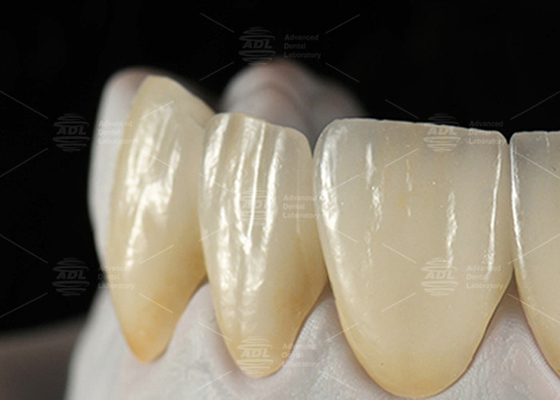 0.3mm-0.7mm Feldspathic EMAX Ceramic Veneers Natural Aesthetic Emax Dental Veneers