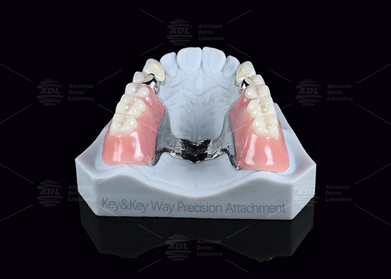 Silver Key And Keyway Attachment Easy Maintenance Precision Attachment Dental