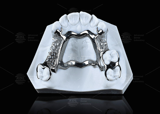 High Strength 3D Printed Titanium Framework With Clear Clasps For Durable Performance