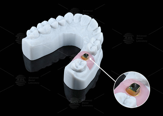 Customized Titanium Base Corrosion Resistance Dental Implants And Solutions