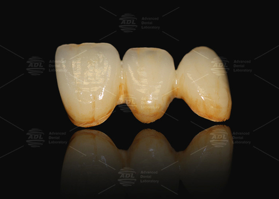 A3 A3.5 Porcelain Fused To Metal Co Cr And Ceramic Dental Crown PFM Cad Cam