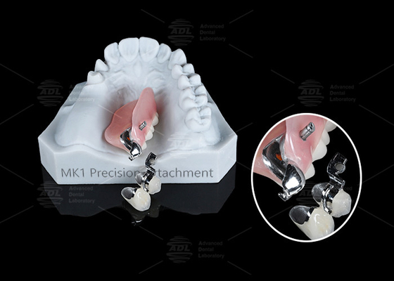 MK1 Attachment Dental Prosthesis Silver Partial Denture Precision Attachments