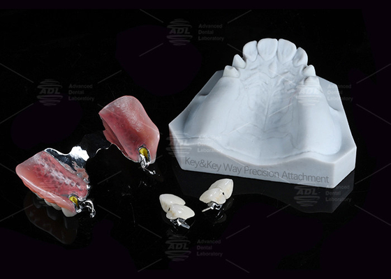 Dental Prostheses Key Way Attachment Precision Attachment Adjustable Retentive Force