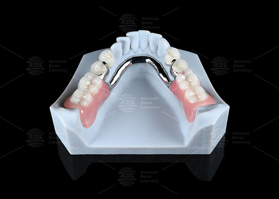 PDF) Distal Extension Removable Partial Denture with
