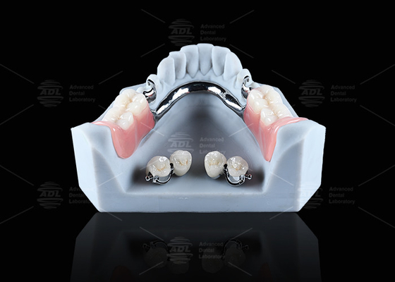 Titanium Dental Implant Ball Attachments Comfortable Secure Denture Retention