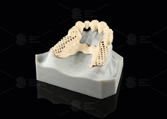 Milled Peek Framework Customizable Digital Partial Dentures Superior Thin