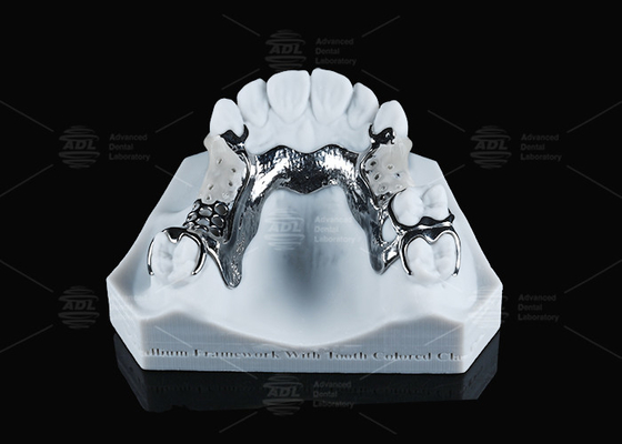 FDA Vitallium Framework With Tooth Colored Clasps For Natural Esthetics