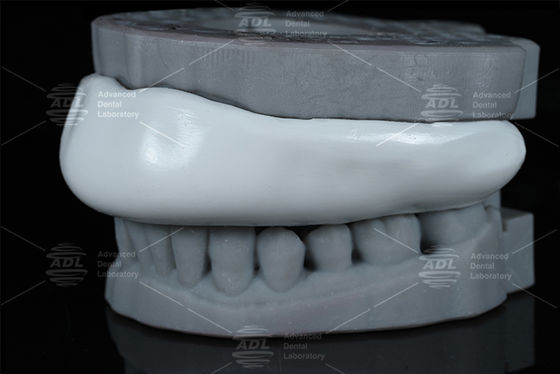 Convenient Occlusal Sport Guard Bite Splint Design Easy To Clean Comfortable Protective Device For Teeth Grinding