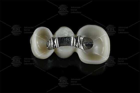 Customizable Reinforcement Titanium Bar Combined with Milled Zirconia providing dental implant framework solutions