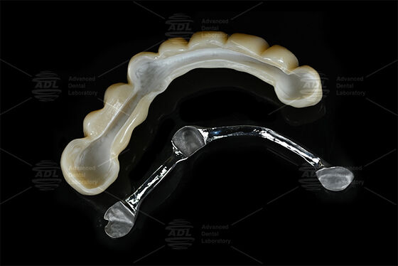 Customizable Reinforcement Titanium Bar Combined with Milled Zirconia providing dental implant framework solutions